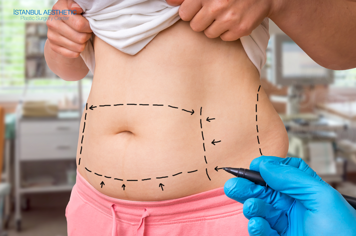 The Ultimate Guide to Tummy Tuck