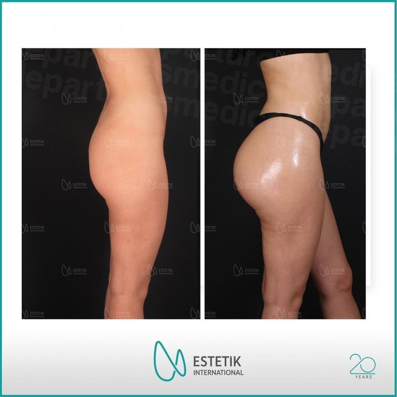 The Ultimate Guide to Brazilian Butt Lift (BBL)