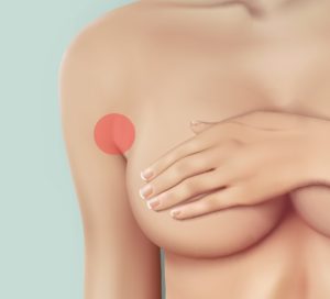 Breast Augmentation Incisions