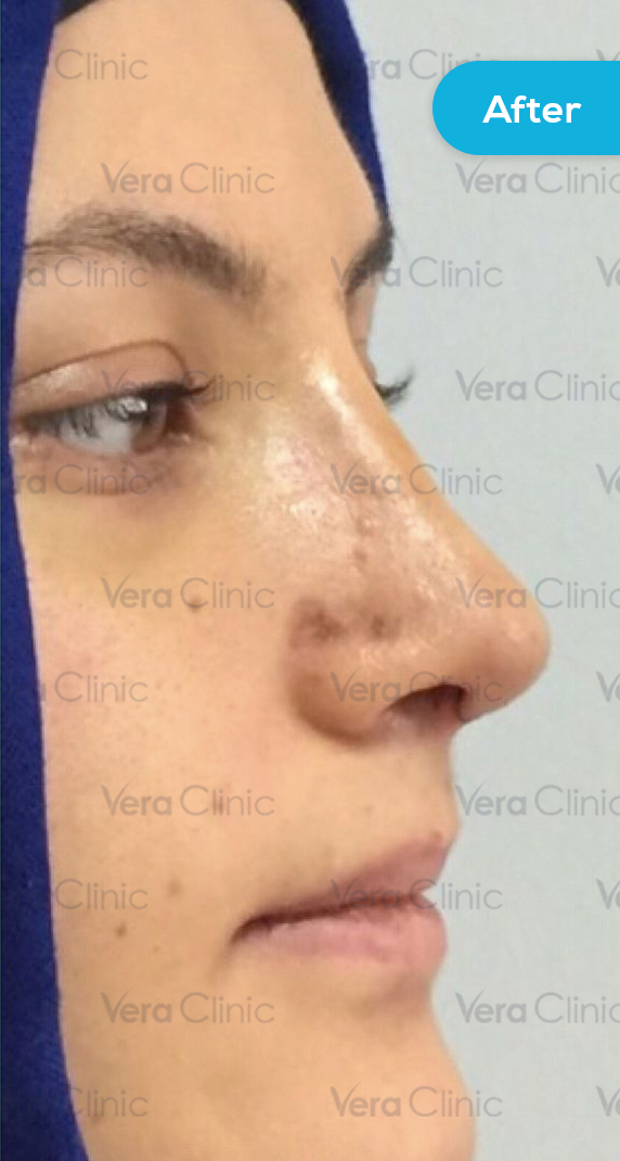 After Rhinoplasty Example