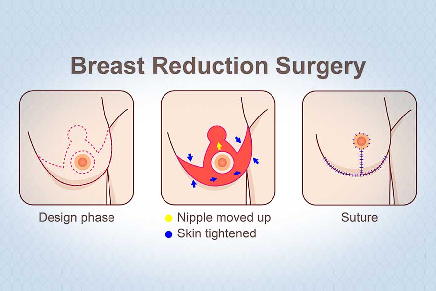 Breast Reduction Process