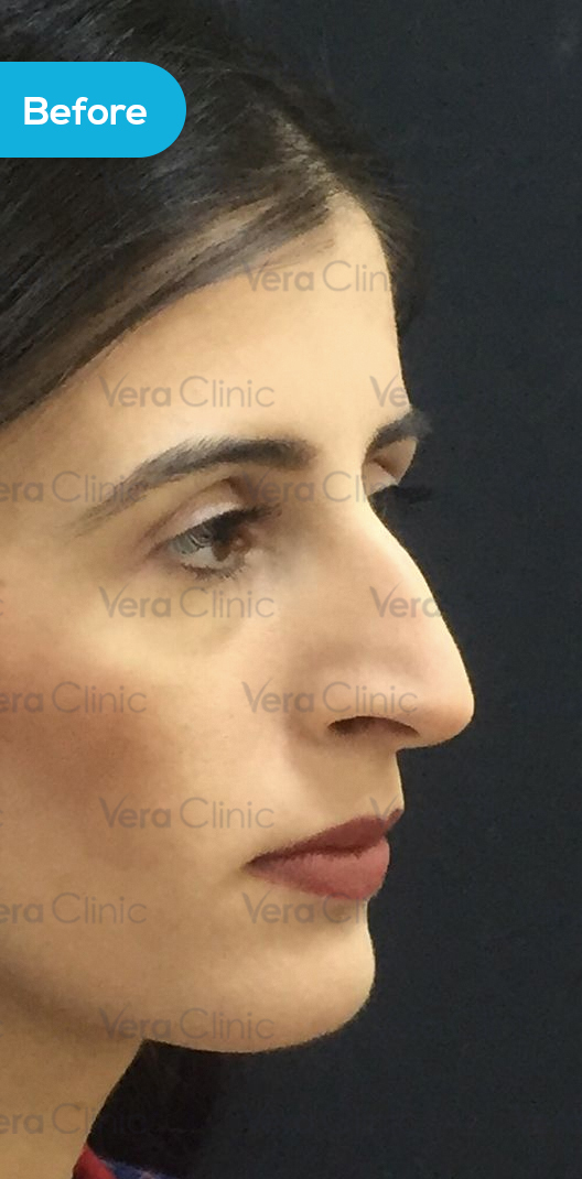 After Rhinoplasty Example