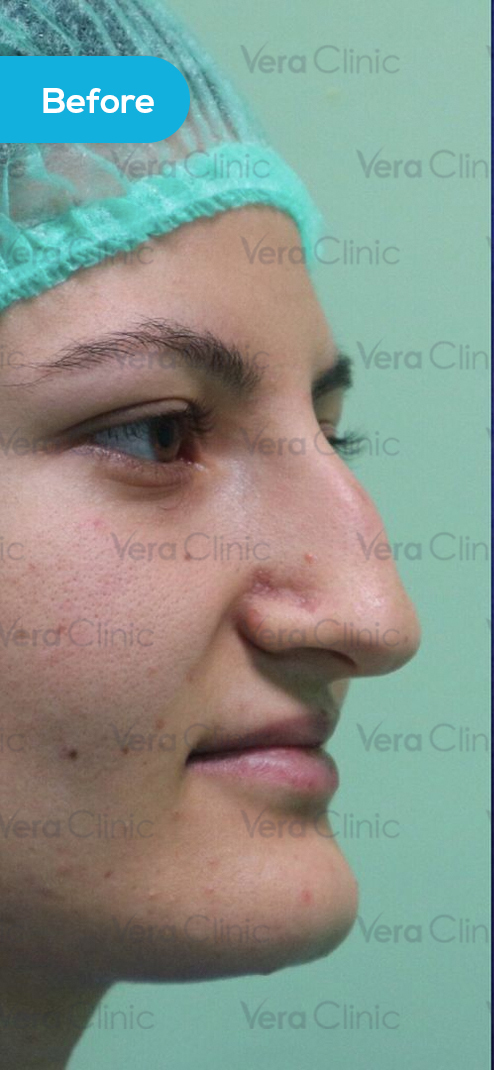 before Rhinoplasty Example