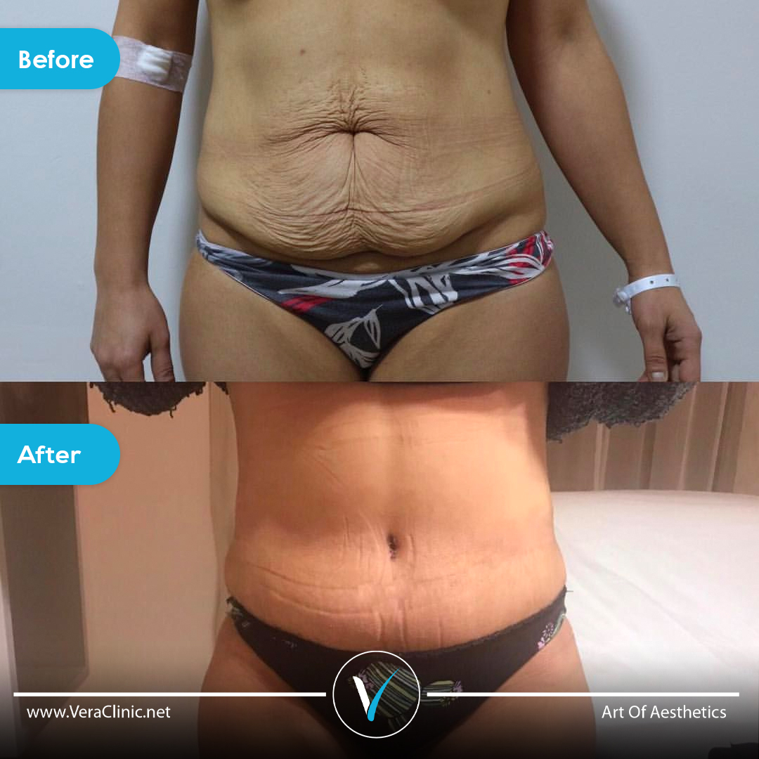 Tummy tuck before and after