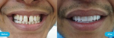 Hollywood Smile Before And After