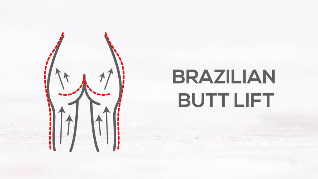 brazilianbuttlift-ss.jpg