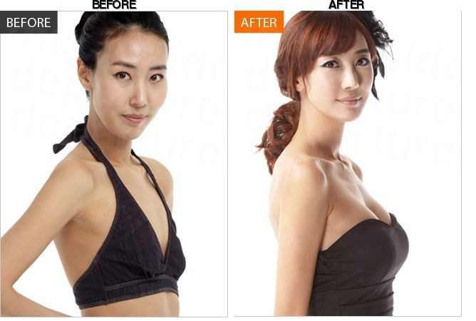 BANOBAGI Plastic Surgery & Aesthetics before-after