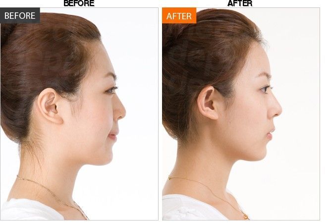 BANOBAGI Plastic Surgery & Aesthetics before-after