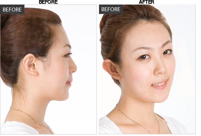 BANOBAGI Plastic Surgery & Aesthetics before-after