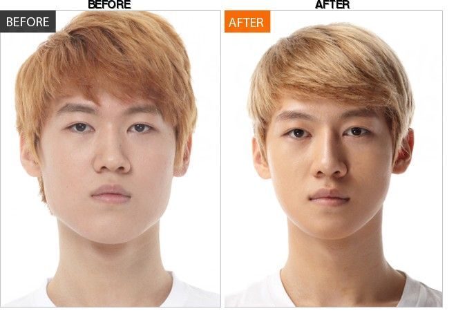 BANOBAGI Plastic Surgery & Aesthetics before-after