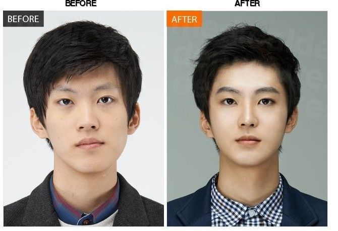 BANOBAGI Plastic Surgery & Aesthetics before-after