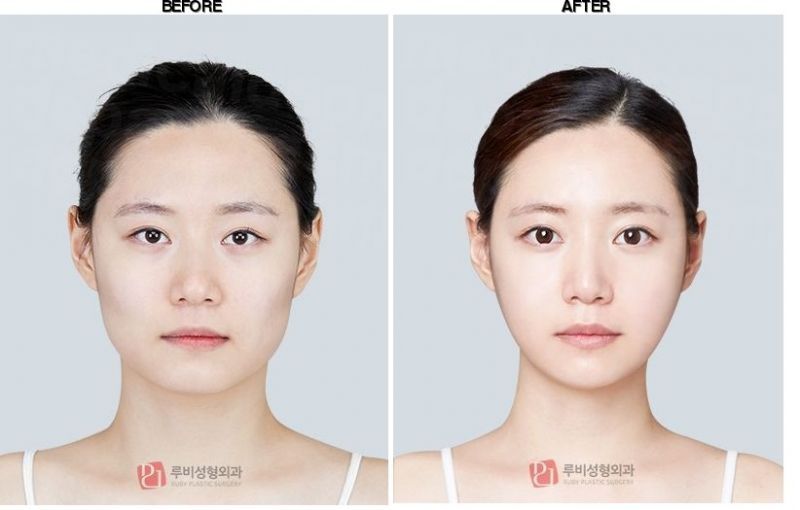 Ruby Plastic Surgery before-after