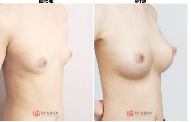 Ruby Plastic Surgery before-after