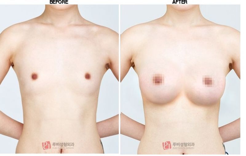 Ruby Plastic Surgery before-after