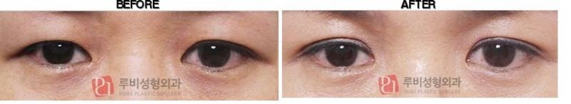 Ruby Plastic Surgery before-after