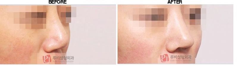 Ruby Plastic Surgery before-after