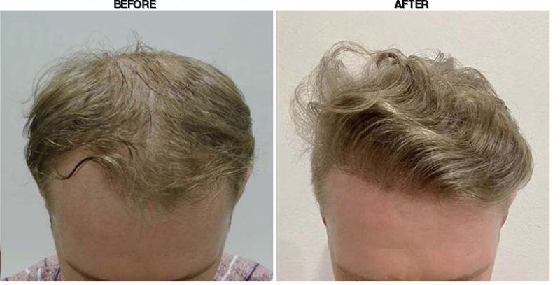 FORHAIR Hair Transplant Korea before-after