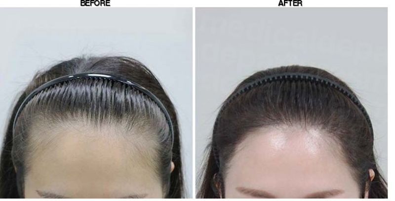 FORHAIR Hair Transplant Korea before-after