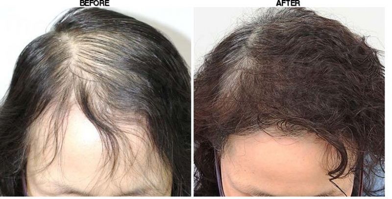 FORHAIR Hair Transplant Korea before-after