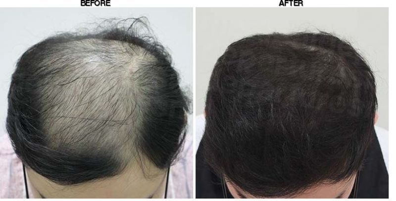 FORHAIR Hair Transplant Korea before-after