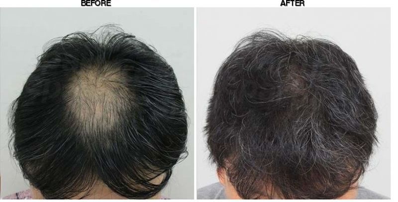 FORHAIR Hair Transplant Korea before-after