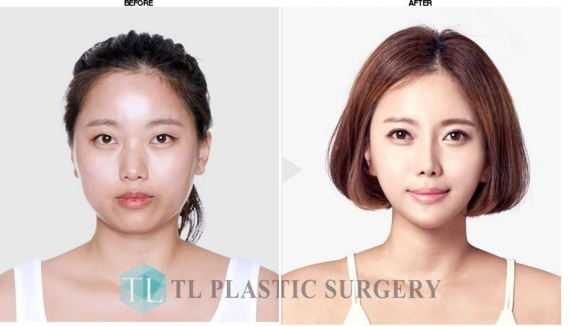 TL Plastic Surgery before-after