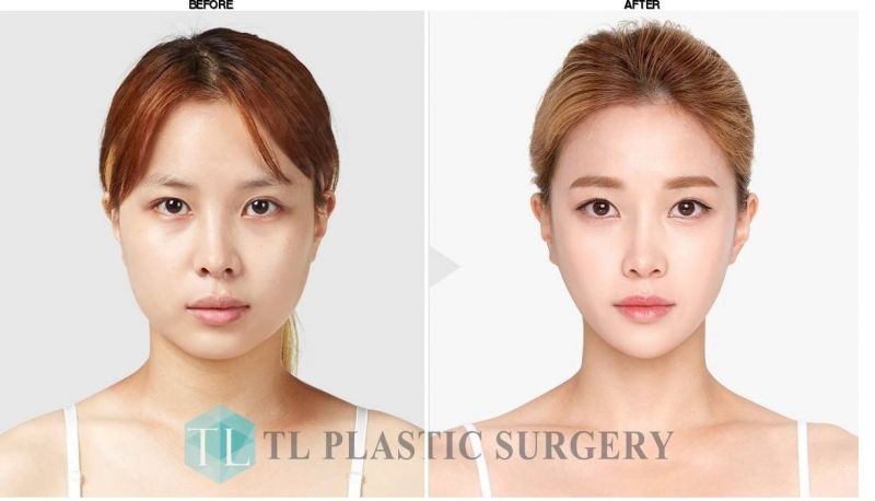 TL Plastic Surgery before-after