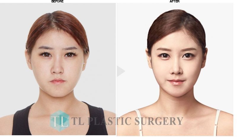 TL Plastic Surgery before-after