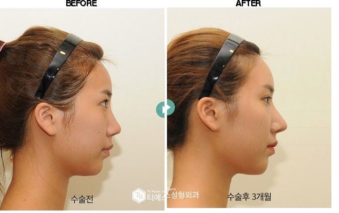 TS Plastic Surgery before-after