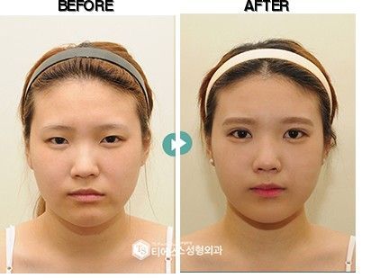 TS Plastic Surgery before-after