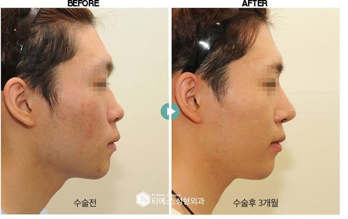 TS Plastic Surgery before-after