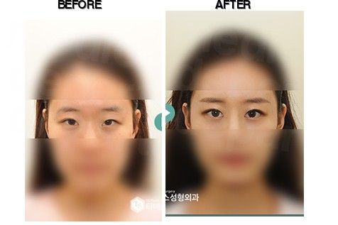 TS Plastic Surgery before-after