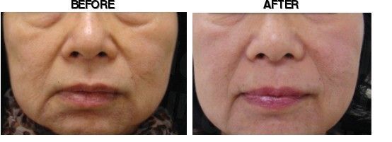 Dr. Kim's Skin Laser & Esthetic before-after
