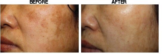 Dr. Kim's Skin Laser & Esthetic before-after