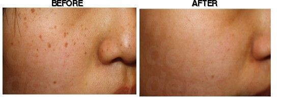 Dr. Kim's Skin Laser & Esthetic before-after