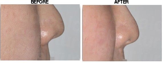 CELLA Plastic Surgery Clinic before-after