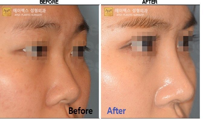 Apex Plastic Surgery before-after