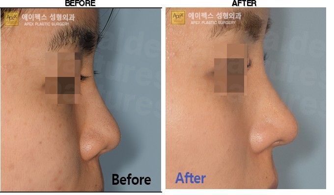 Apex Plastic Surgery before-after