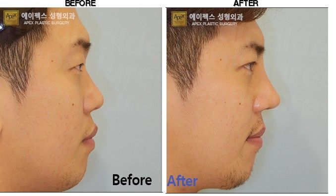 Apex Plastic Surgery before-after