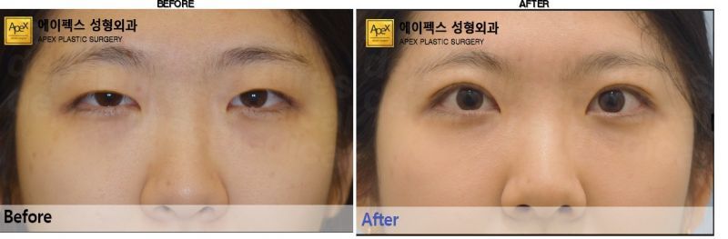 Apex Plastic Surgery before-after