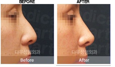 DEESSE Plastic Surgery before-after