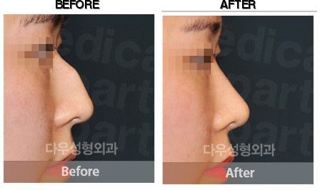 DEESSE Plastic Surgery before-after