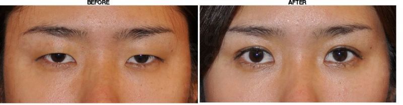 DEESSE Plastic Surgery before-after