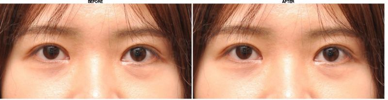 DEESSE Plastic Surgery before-after