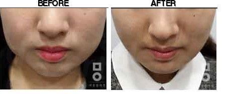 Miall Korean Medicine Clinic (Ansan) before-after
