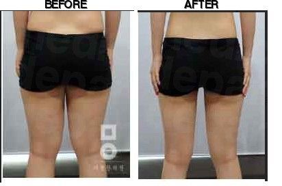 Miall Korean Medicine Clinic (Incheon) before-after