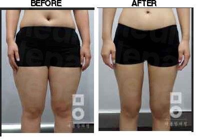 Miall Korean Medicine Clinic (Incheon) before-after