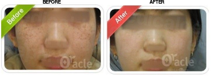 Oracle Clinic (Sinchon) before-after