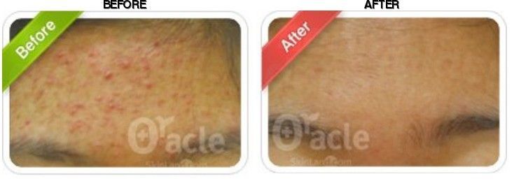 Oracle Clinic (Sinchon) before-after