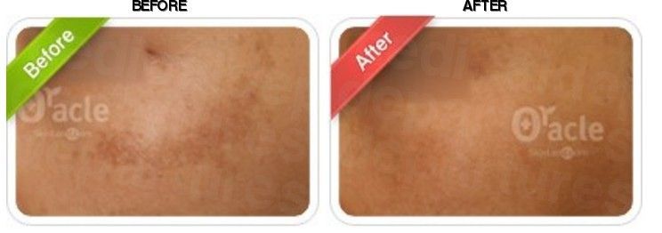 Oracle Clinic (Sinchon) before-after